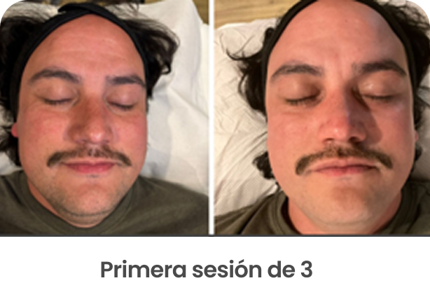 rojeces antes y después