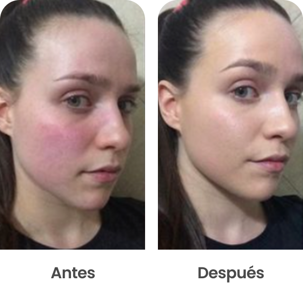 Rojeces antes y después